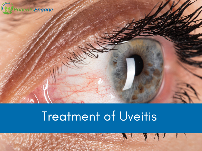 Treatment of Uveitis PatientsEngage